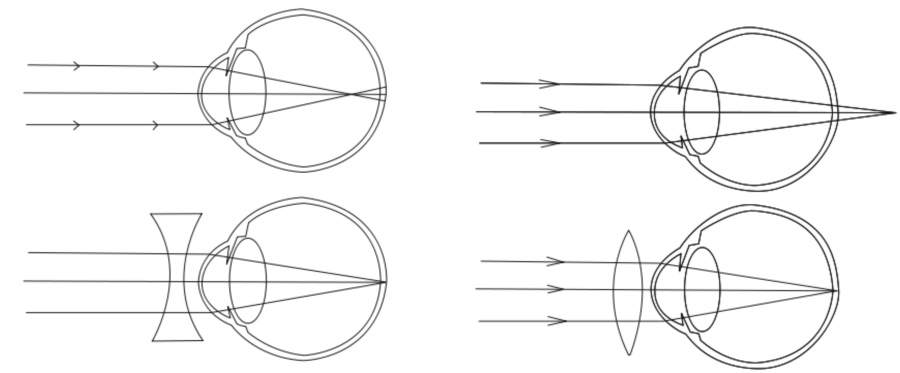 Akkomodációs hibák (balra: miópiás szem, jobbra: hiperópiás szem, alul: ezek korrekciói)